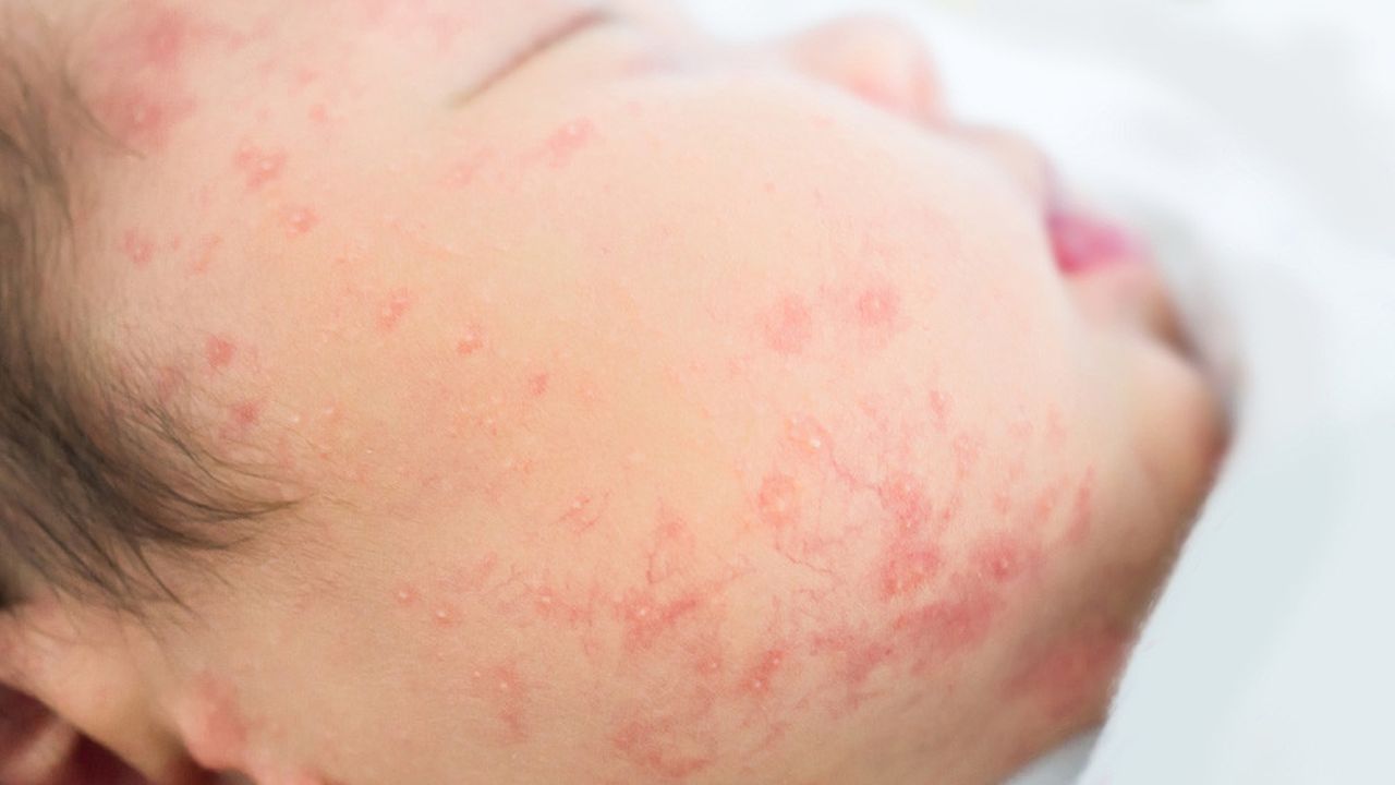 Alergi kulit bayi