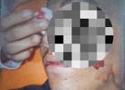 Hampir Setahun Dilapor ke Polres Langkat, Kasus Penganiayaan Hingga Mata Kiri Lepas, Masih Ngambang